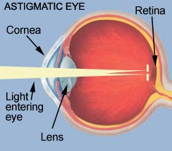 Astigmatism