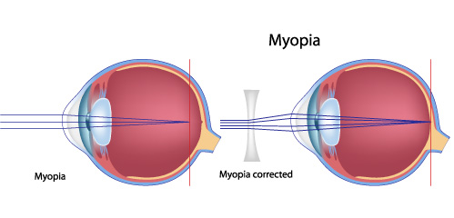 myopia