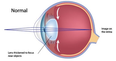 presbyopia_normal