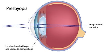 presbyopia