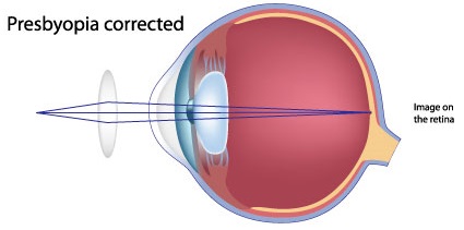 presbyopia_fixed